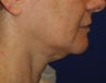 Neck lift surgery