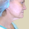 Neck Lift