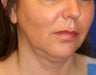 Neck Liposuction