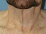 Neck Lift