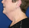 Facelift, Necklift