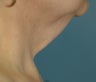 Neck Lift