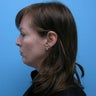 Neck Lift