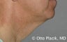 Cervicoplasty