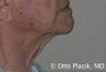 Cervicoplasty