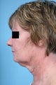 Neck Lift