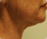 Face lift and Neck Lift