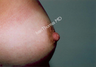 Nipple Surgery