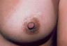 Nipple Surgery