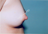 Nipple Surgery