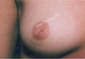 Nipple Surgery
