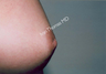 Nipple Surgery