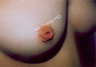 Nipple Surgery