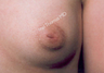 Nipple Surgery