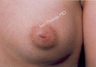 Nipple Surgery