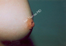 Nipple Surgery