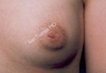 Nipple Surgery