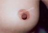 Nipple Surgery