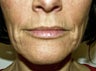 Sculptra, Radiesse, Restylane, and Botox Injection, and Obagi Nu Derm