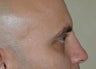 Non-Surgical Rhinoplasty