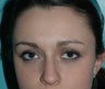 Non-Surgical Rhinoplasty
