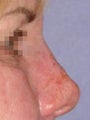 Nonsurgical Nose Job with Radiesse