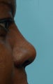 Rhinoplasty, Non-Surgical