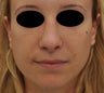 Non-surgical rhinoplasty