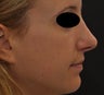 Non-surgical rhinoplasty