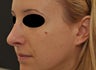 Non-surgical rhinoplasty