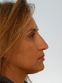 Non Surgical Rhinoplasty Juvederm Ultra Plus
