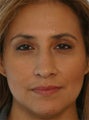 Non Surgical Rhinoplasty Juvederm Ultra Plus