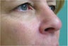 Radiesse for nose re-shaping