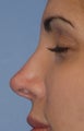 Non-surgical Revision Rhinoplasty