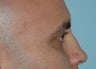 Non-Surgical Rhinoplasty