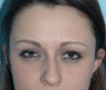 Non-Surgical Rhinoplasty