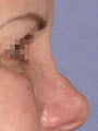 Nonsurgical Nose Job with Radiesse