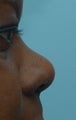 Rhinoplasty, Non-Surgical