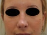 Non-surgical rhinoplasty