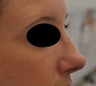 Non-surgical rhinoplasty