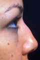 Non-surgical nose job