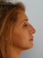 Non Surgical Rhinoplasty Juvederm Ultra Plus