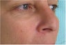 Radiesse for nose re-shaping