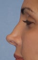 Non-surgical Revision Rhinoplasty