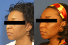 Facelift, Laser Skin Rejuvenation