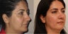 Liquid Face lift