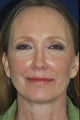 Non Surgical Facelift