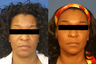 Facelift, Laser Skin Rejuvenation