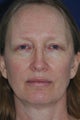 Non Surgical Facelift