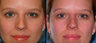 Non-surgical Nose Job - Non-surgical rhinoplasty